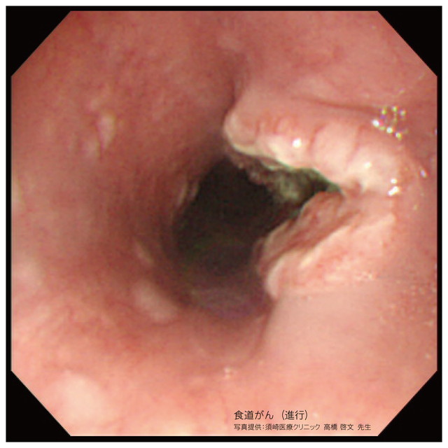 【画像】食道がん