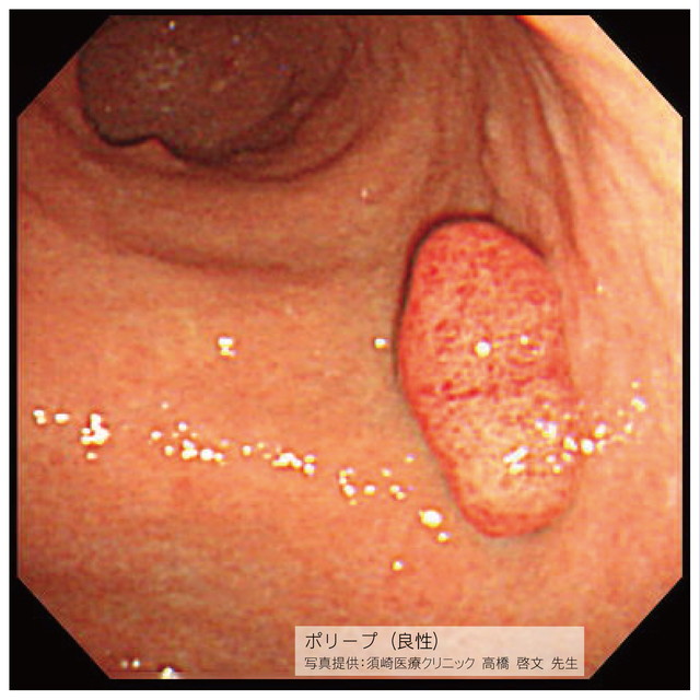 【画像】ポリープ（良性）