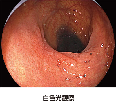 【画像】白色光観察/上部内視鏡