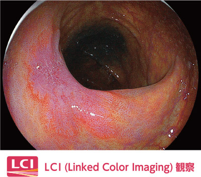【画像】LCI/上部内視鏡