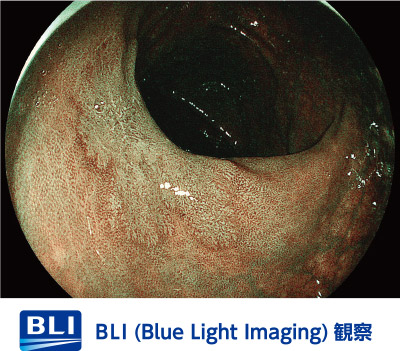 【画像】BLI/上部内視鏡