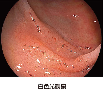 【画像】白色光観察/大腸カメラ