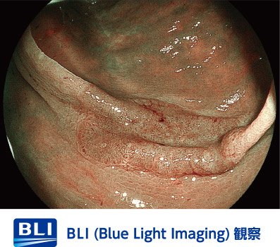 【画像】BLI/大腸カメラ
