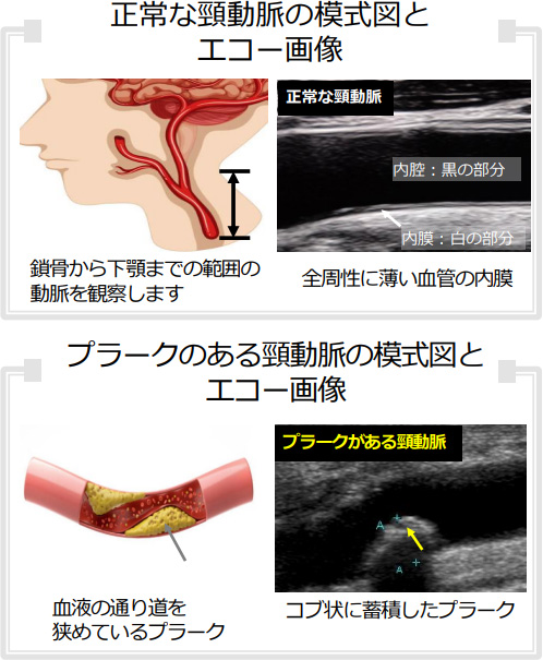 正常な頸動脈の模式図とエコー画像、プラークのある頸動脈の模式図とエコー画像
