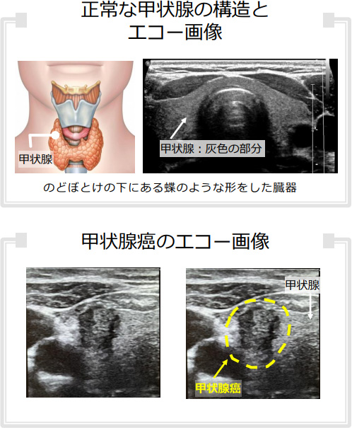 正常な甲状腺の構造とエコー画像、甲状腺癌のエコー画像