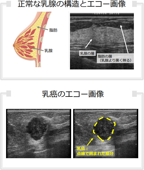 正常な乳腺の構造とエコー画像、乳癌のエコー画像
