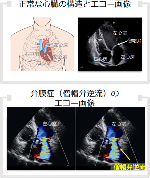 正常な心臓の構造とエコー画像、弁膜症（僧帽弁逆流）のエコー画像