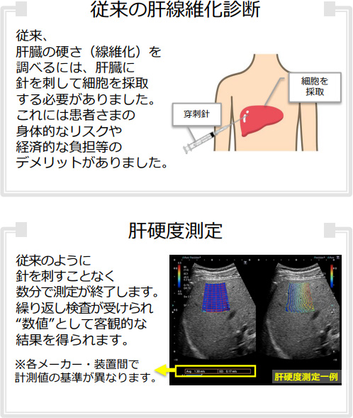 従来の肝線維化診断、肝硬度測定