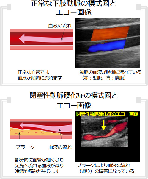 正常な下肢動脈の模式図とエコー画像、閉塞性動脈硬化症の模式図とエコー画像