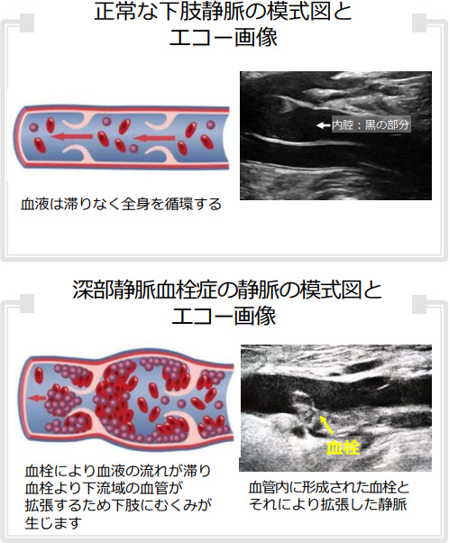 正常な下肢静脈の模式図とエコー画像、深部静脈血栓症の静脈の模式図とエコー画像