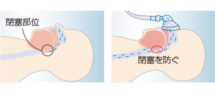 【イラスト】CPAPの図解