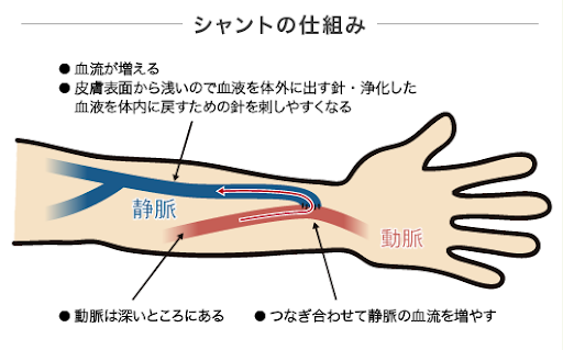 【画像】シャントの仕組み