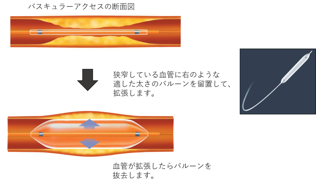 【画像】バスキュラーアクセスの断面図