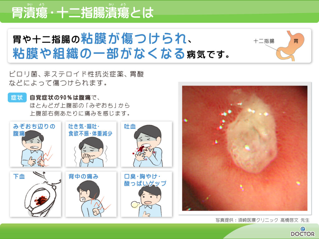 胃潰瘍・十二指腸潰瘍とは…胃や十二指腸の粘膜が傷つけられ、粘膜や組織の一部がなくなる病気です。