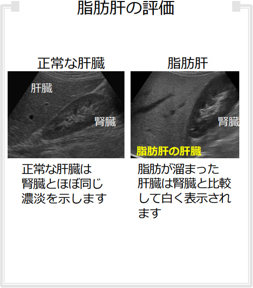 脂肪肝の評価